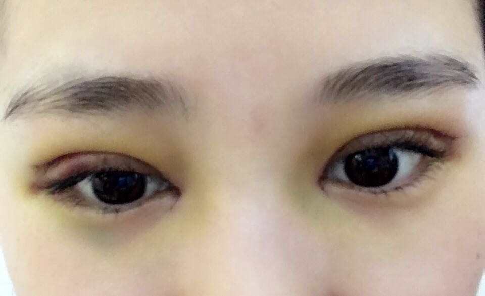 蚌埠韓美美萊整形醫(yī)生鄭捷做開眼角怎么樣？附案例效果圖