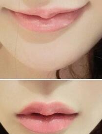 巴中時光醫(yī)學(xué)美容門診部做玻尿酸豐唇效果怎么樣？附李紅強豐唇案例