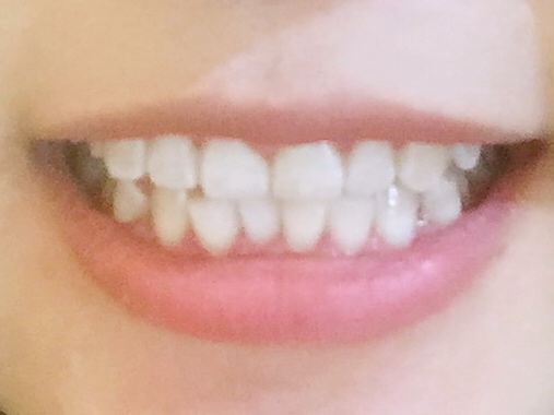 安慶渡江口腔醫(yī)院張良斌醫(yī)生做超聲波洗牙效果怎么樣？附洗牙案例效果圖