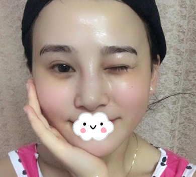 蚌埠韓美美萊整形醫(yī)生歷芳做耳軟骨隆鼻怎么樣？附耳軟骨隆鼻案例對(duì)比圖
