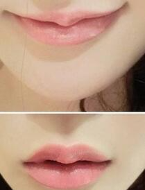 巴中時(shí)光醫(yī)學(xué)美容門診部做玻尿酸豐唇效果怎么樣？附李紅強(qiáng)豐唇案例