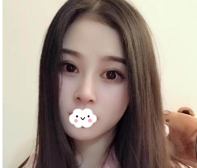 蚌埠韓美美萊整形醫(yī)生歷芳做耳軟骨隆鼻怎么樣？附耳軟骨隆鼻案例對(duì)比圖