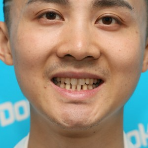 鞍山時(shí)代口腔門診部做瓷貼面怎么樣？附孫興國(guó)醫(yī)生瓷貼面案例效果圖