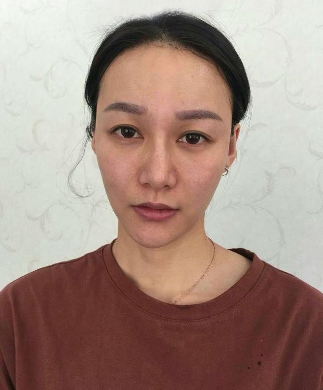鞍山王景醫(yī)療美容外科診所做光子嫩膚怎么樣？附王景醫(yī)生案例效果圖