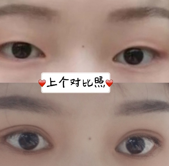 鞍山菲之都醫(yī)療整形醫(yī)院做開眼角+全切雙眼皮效果怎么樣？附藺嬌婷醫(yī)生案例