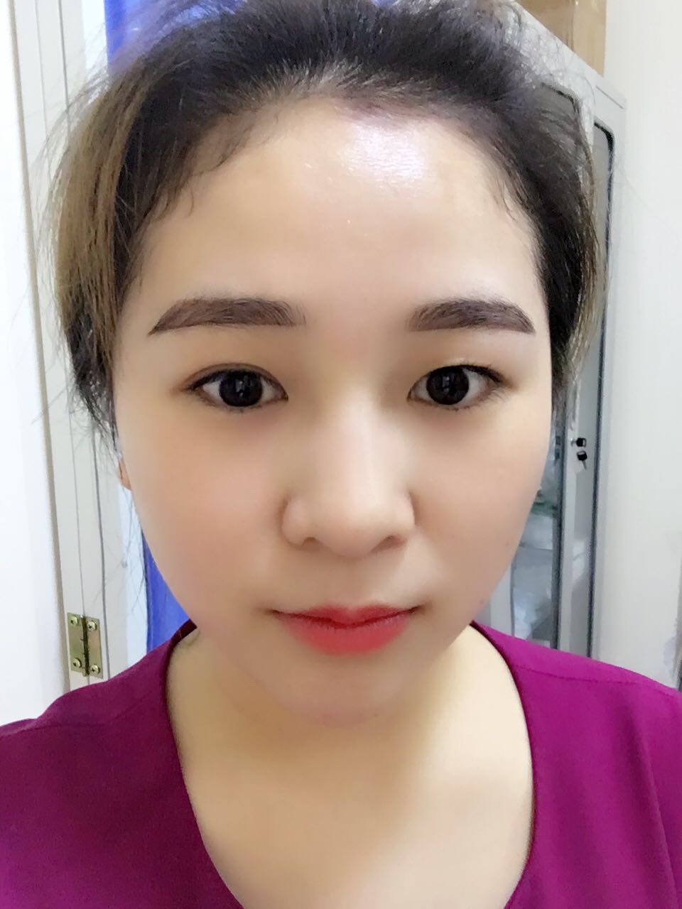 蚌埠韓美美萊整形醫(yī)生鄭捷做開眼角怎么樣？附案例效果圖