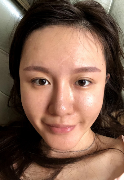 蚌埠韓美美萊整形醫(yī)生張燕做自體脂肪豐面頰效果怎么樣？附案例效果圖