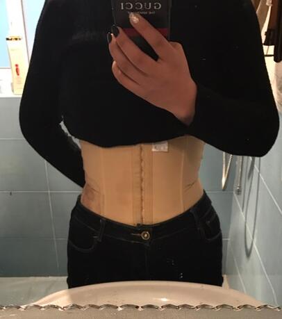 保定現(xiàn)代女子醫(yī)院整形美容中心做腰腹部吸脂怎么樣？附林秀蓮醫(yī)生案例效果圖