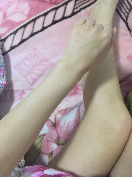 蚌埠市第三人民醫(yī)院燒傷整形科李方奇注射美白針效果怎么樣？安全嗎？附案例