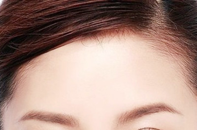 長沙亞韓醫(yī)學美容醫(yī)院自體脂肪豐額頭