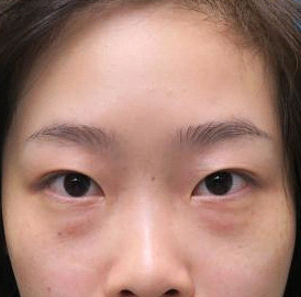 保定安卓貝拉醫(yī)療美容門診部孫大山醫(yī)生做雙眼皮+去眼袋怎么樣？附案例效果對比圖