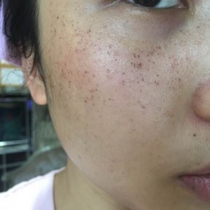 寶雞皮膚病醫(yī)院文東亮醫(yī)生做臉部祛斑效果怎么樣？附臉部祛斑案例