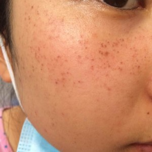 寶雞皮膚病醫(yī)院文東亮醫(yī)生做臉部祛斑效果怎么樣？附臉部祛斑案例