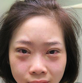 保定安卓貝拉醫(yī)療美容門診部孫大山醫(yī)生做雙眼皮+去眼袋怎么樣？附案例效果對(duì)比圖