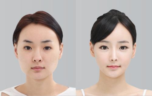 想做歐式雙眼皮，什么是歐式雙眼皮？