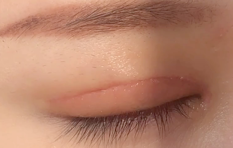 全切雙眼皮有哪些優(yōu)點(diǎn)？
