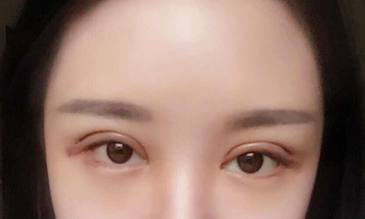 全切雙眼皮手術(shù)多少錢一次？