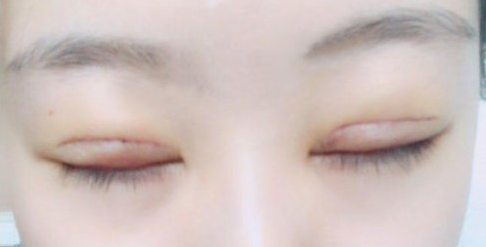 全切雙眼皮術(shù)后會留疤嗎？