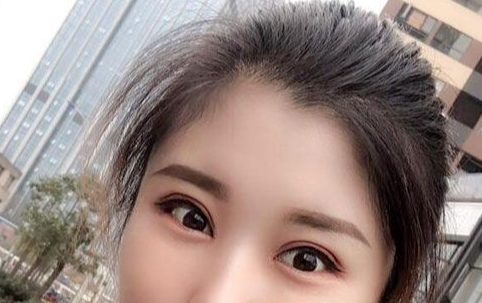 全切雙眼皮多長(zhǎng)時(shí)間恢復(fù)自然？
