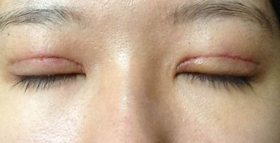全切雙眼皮到底疼不疼？雙眼皮全切需要拆線嗎？