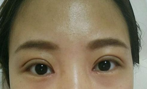 全切雙眼皮術(shù)后會(huì)留疤嗎？