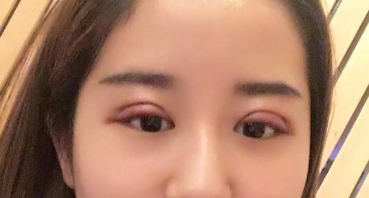 全切雙眼皮好不好？