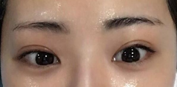 雙眼皮全切的風險有哪些？