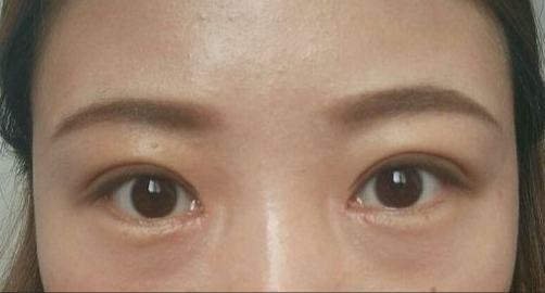 全切雙眼皮能保持多久？全切雙眼皮的危害有哪些？