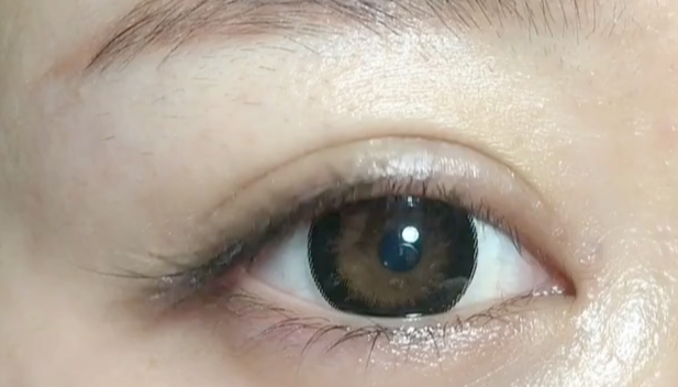 全切雙眼皮失敗可以修復(fù)嗎？