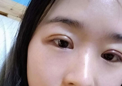 全切雙眼皮大概多少錢？全切雙眼皮多久能恢復(fù)？