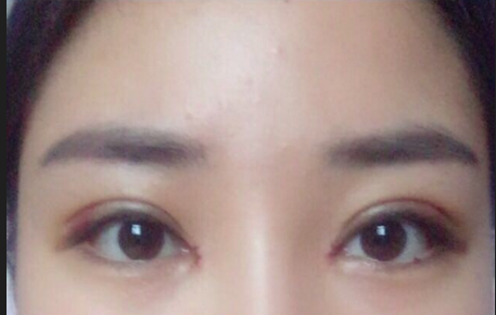 雙眼皮全切術(shù)后注意事項(xiàng)有哪些？