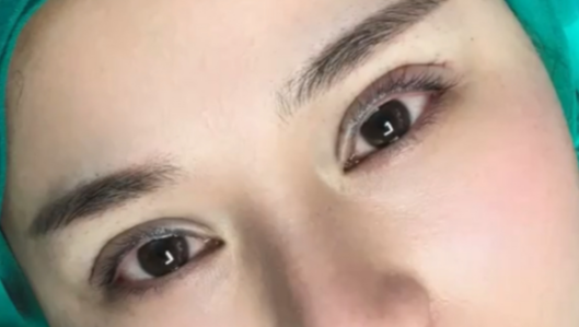 全切雙眼皮有危險嗎？