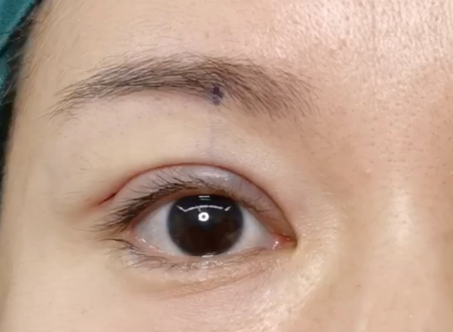 全切雙眼皮會(huì)消失嗎？全切雙眼皮多久定型？