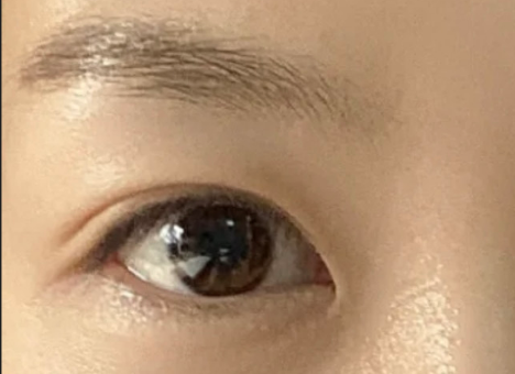 全切雙眼皮效果怎么樣？全切雙眼皮多久自然？
