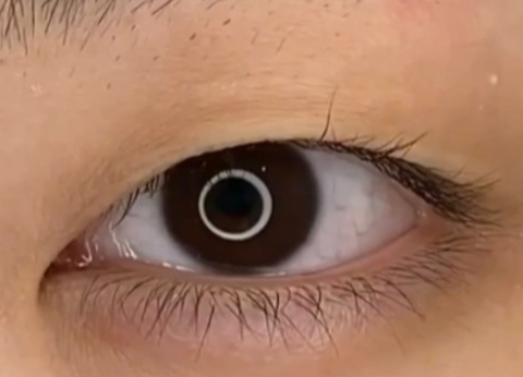 全切雙眼皮疤痕多久能消失？全切雙眼皮幾天可以洗臉？
