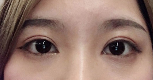 埋線雙眼皮幾天可以碰水？埋線雙眼皮有哪些注意事項(xiàng)？