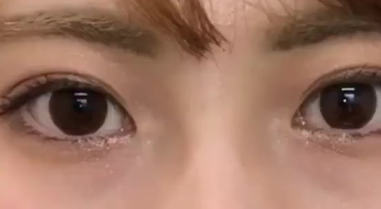 雙眼皮埋線后還可以開眼角嗎？做埋線雙眼皮有什么危險？