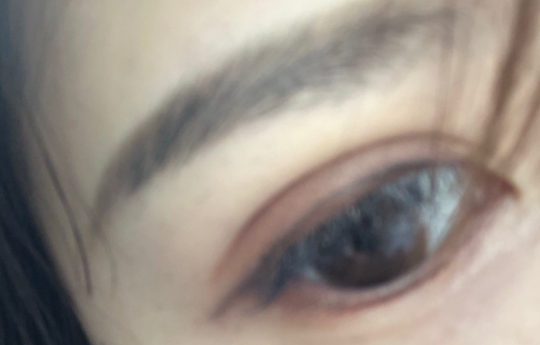 埋線雙眼皮疼嗎？埋線雙眼皮手術(shù)優(yōu)勢有哪些？