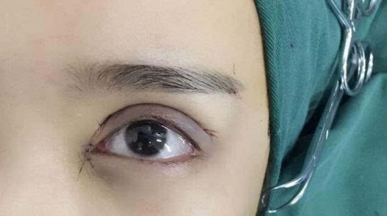 埋線雙眼皮會(huì)不會(huì)脫線？