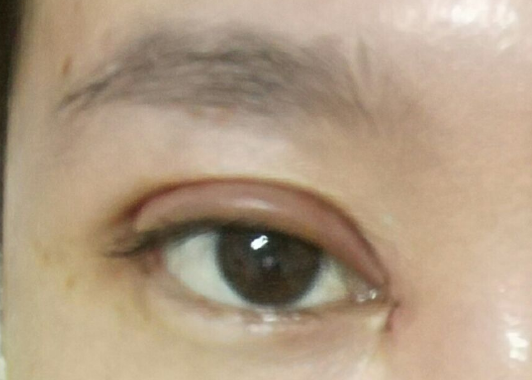 埋線雙眼皮可以維持幾年？