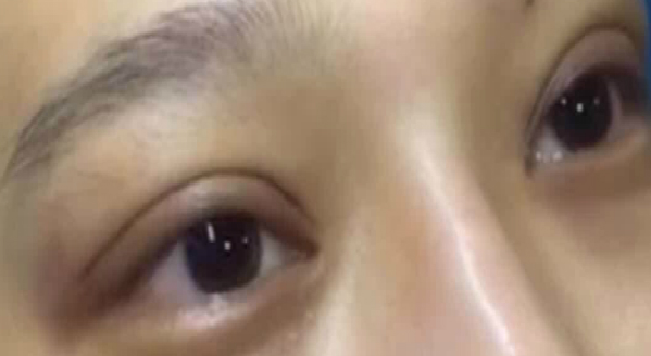 埋線(xiàn)雙眼皮大概能保持幾年??？埋線(xiàn)雙眼皮需要拆線(xiàn)嗎？