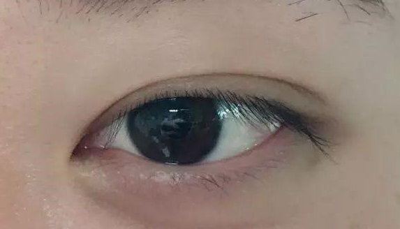 埋線雙眼皮有沒有危害？