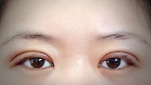 定點(diǎn)雙眼皮幾天能恢復(fù)好？定點(diǎn)做雙眼皮多少錢？