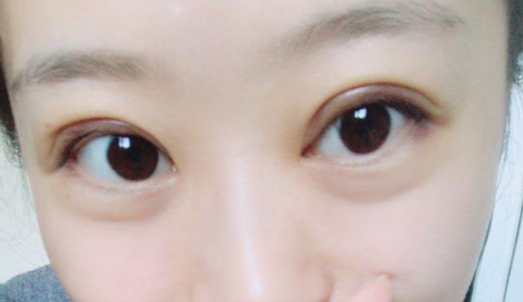定點(diǎn)雙眼皮能維持幾年？