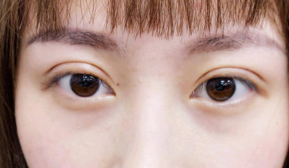 定點(diǎn)雙眼皮是什么意思？雙眼皮定點(diǎn)能維持多久？