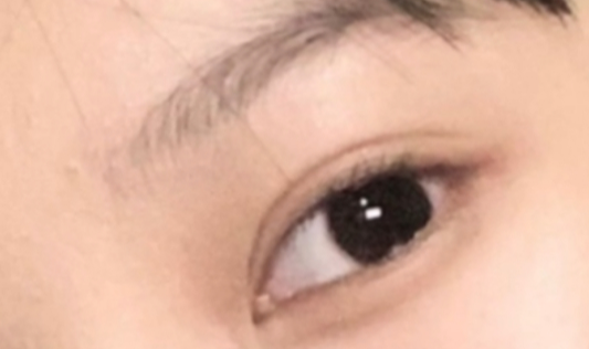 定點(diǎn)雙眼皮疼嗎？定點(diǎn)雙眼皮做完要多久時(shí)間？