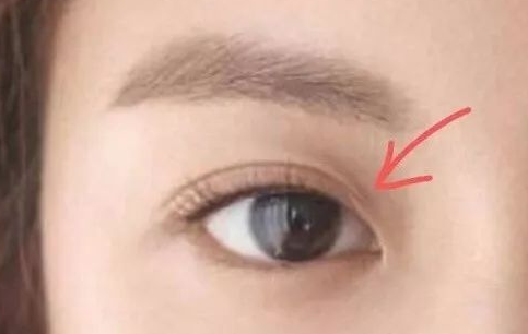 定點(diǎn)雙眼皮一般多少錢？