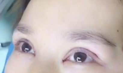 定點雙眼皮手術效果自然嗎？定點雙眼皮失敗怎么修復？