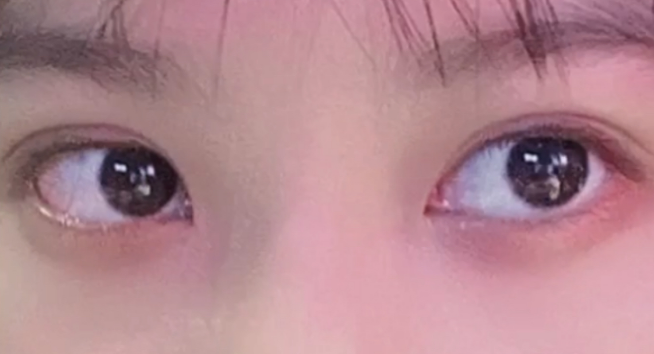 雙眼皮定點(diǎn)能維持多久？