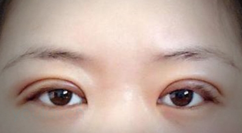 定點(diǎn)雙眼皮需要多長(zhǎng)時(shí)間？